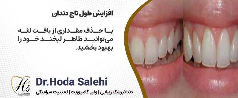 دکتر هدی صالحی|اصلاح طرح لبخند لثه‌ای با افزایش طول تاج دندان