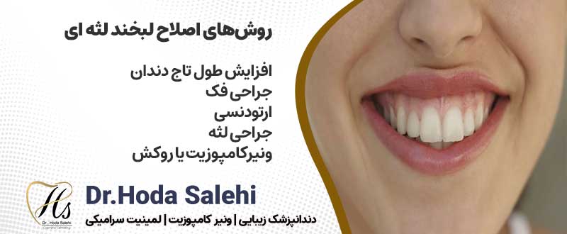 دکتر هدی صالحی|دندانپزشک زیبایی در اصفهان ارائه دهنده روش‌های اصلاح لبخند لثه ای