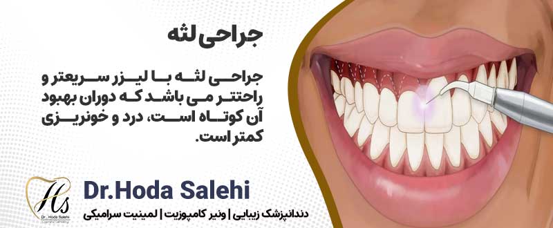 اصلاح طرح لبخند لثه‌ای با جراحی لثه| دکتر هدی صالحی