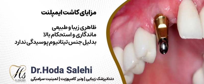 مزایای کاشت ایمپلنت دندان در اصفهان| دکتر هدی صالحی