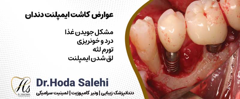 عوارض کاشت ایمپلنت دندان| دکتر هدی صالحی