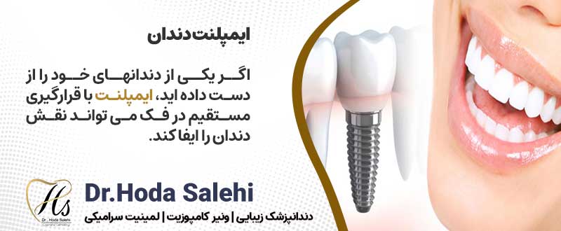 اصلاح طرح لبخند با روش ایمپلنت دندان