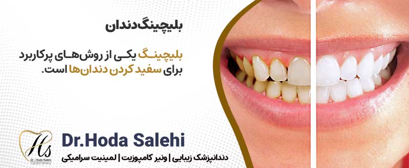 اصلاح طرح لبخند با روش بلیچینگ دندان