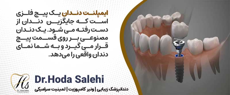 دکتر هدی صالحی ارائه دهنده ایمپلنت دندان در اصفهان