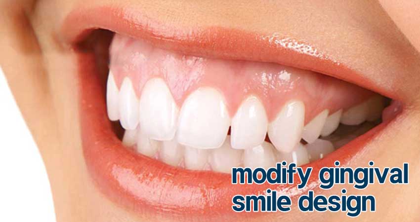 اصلاح طرح لبخند لثه ای در اصفهان توسط دندانپزشک هدی صالحی
