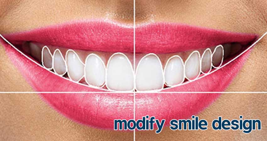 اصلاح طرح لبخند در اصفهان توسط دندانپزشک دکتر صالحی