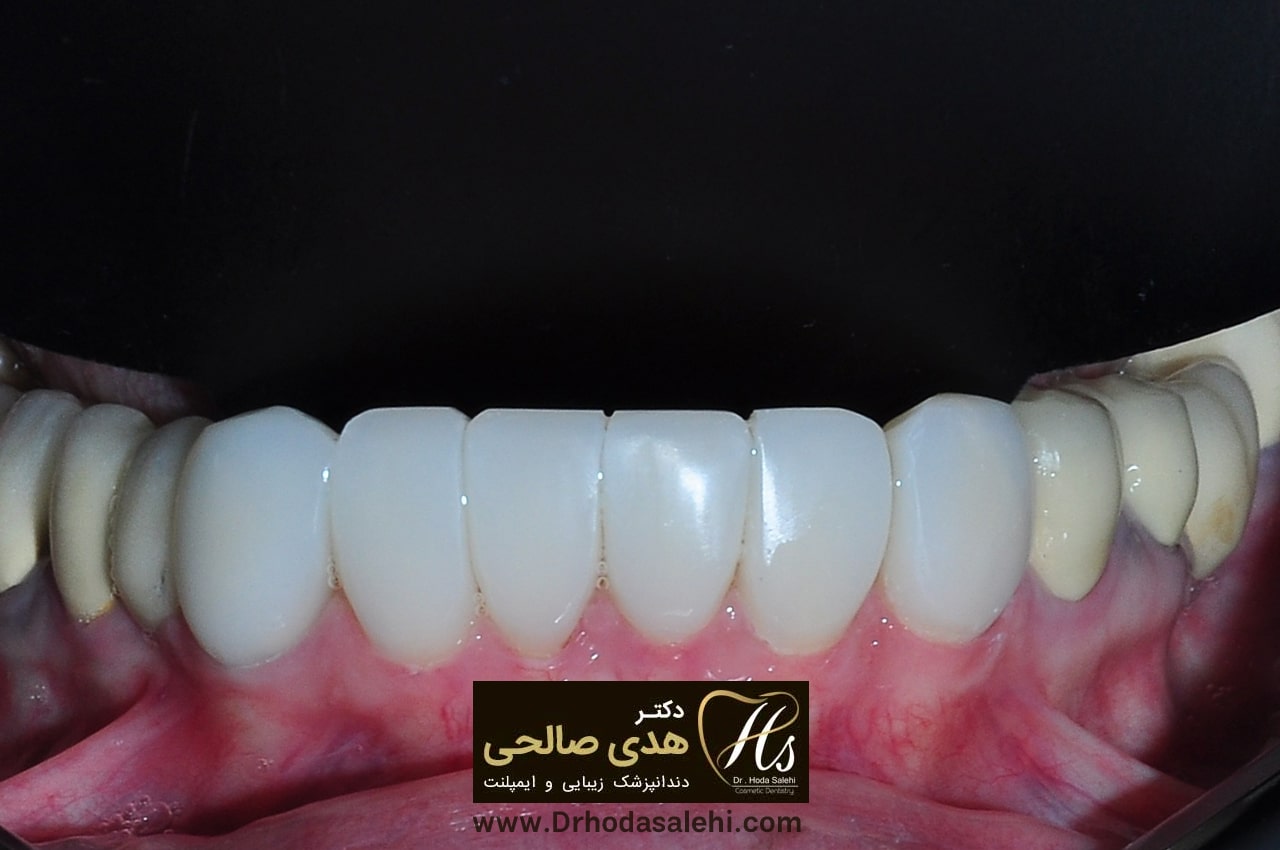 بعد از انجام لمینت | دکتر هدی صالحی دندانپزشک زیبایی اصفهان