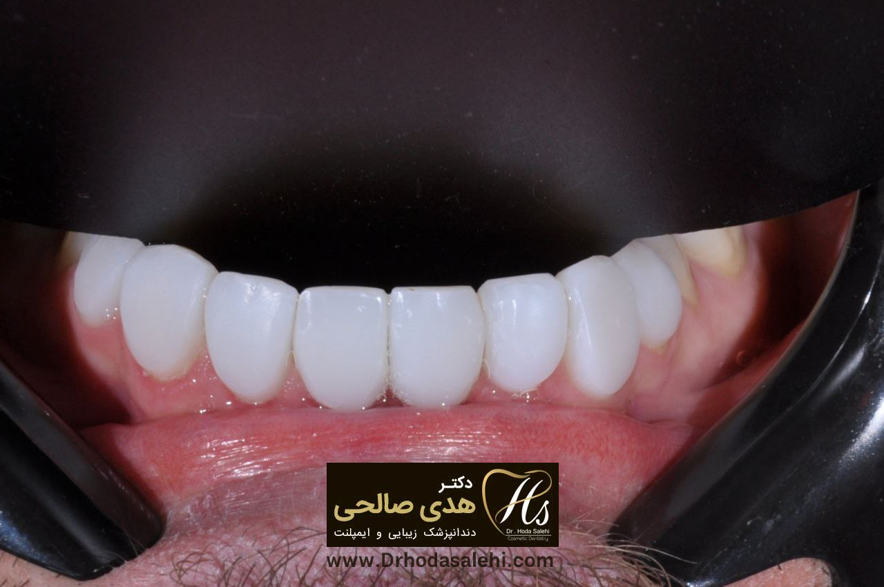 بعد از انجام لمینت | دکتر هدی صالحی دندانپزشک زیبایی اصفهان