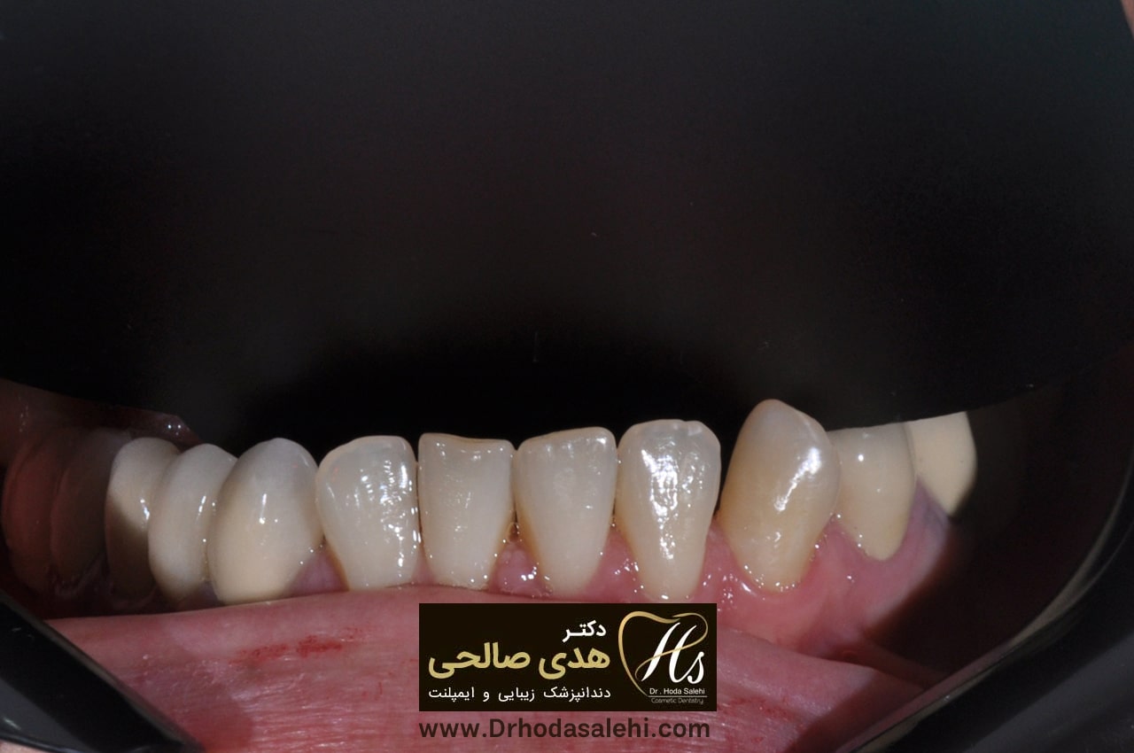 قبل ا انجام لمینت | دکتر هدی صالحی دندانپزشک زیبایی اصفهان