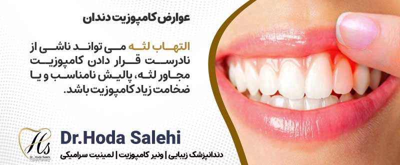 عوارض ونیرکامپوزیت دندان| دکتر هدی صالحی