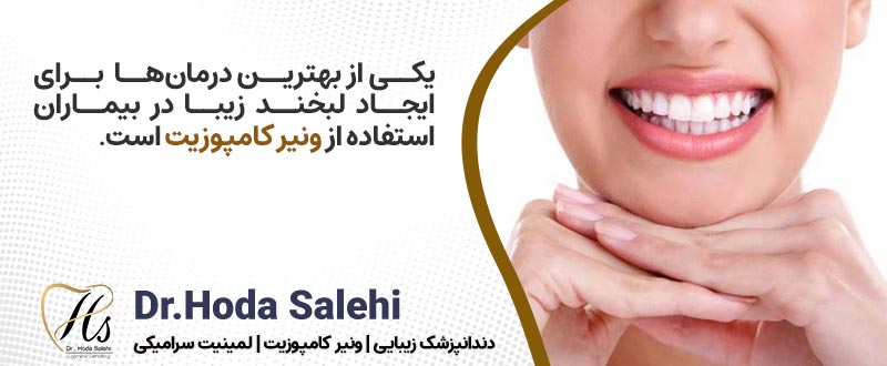 دکتر هدی صالحی دندانپزشک زیبایی در اصفهان ارائه دهنده ونیر کامپوزیت 