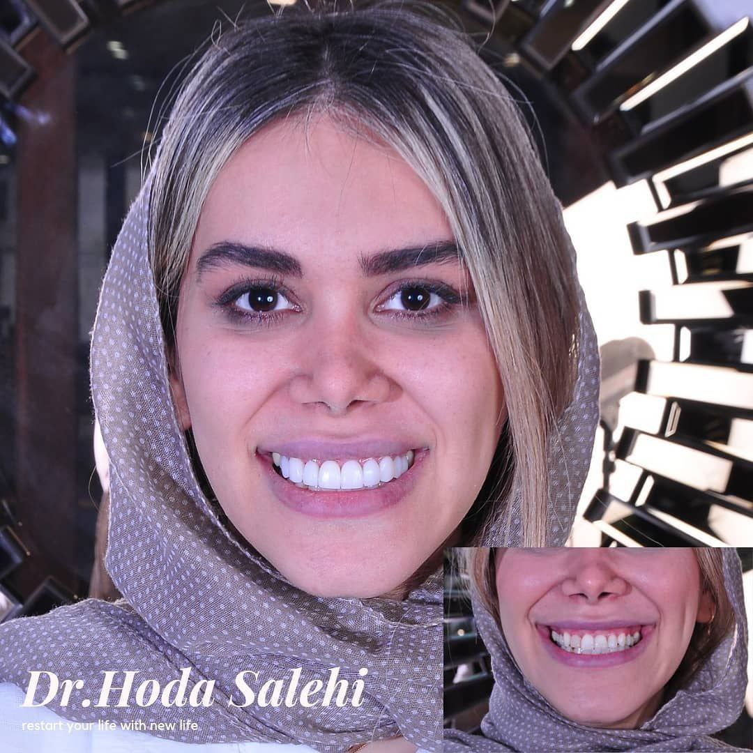 دکتر هدی صالحی|دندانپزشک زیبایی در اصفهان ارائه دهنده لمینت سرامیکی