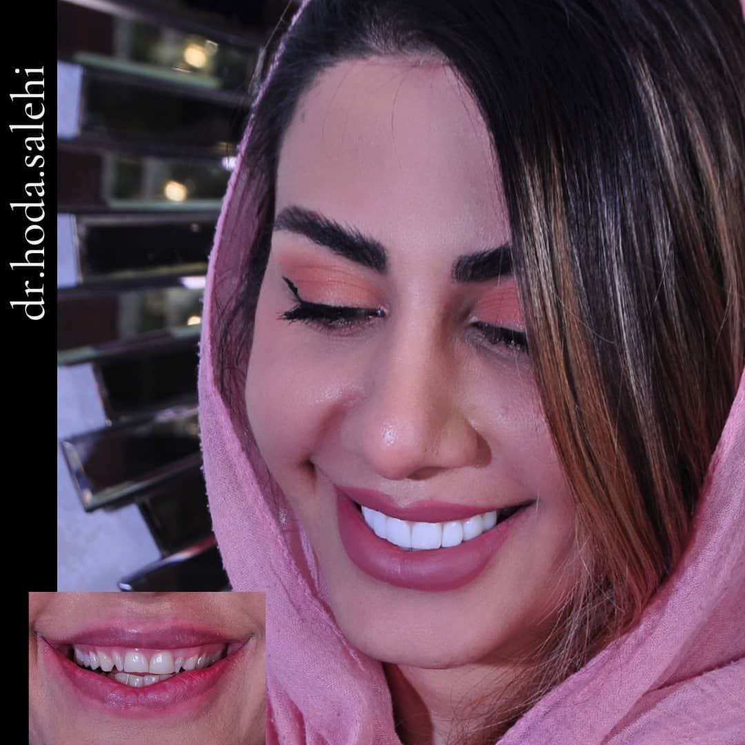 دکتر هدی صالحی|دندانپزشک زیبایی در اصفهان ارائه دهنده لمینت سرامیکی