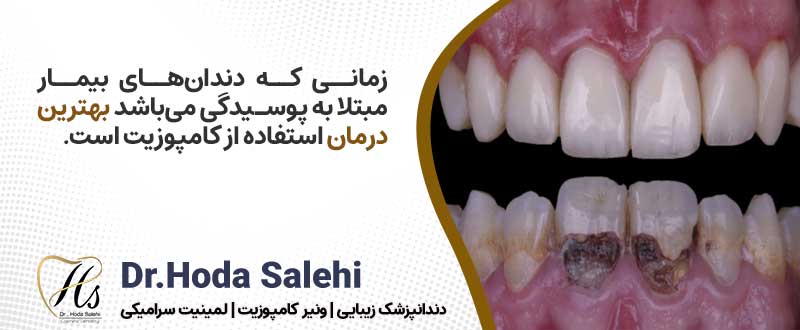 اصلاح طرح لبخند با کامپوزیت برای دندان‌های پوسیده