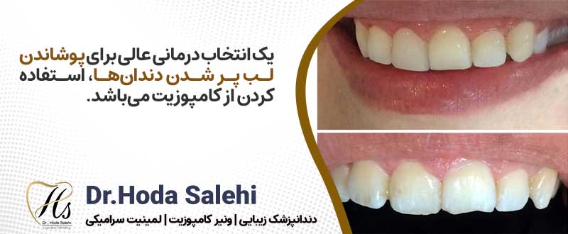 اصلاح طرح لبخند با کامپوزیت برای دندان‌هایی که لب پر شدن
