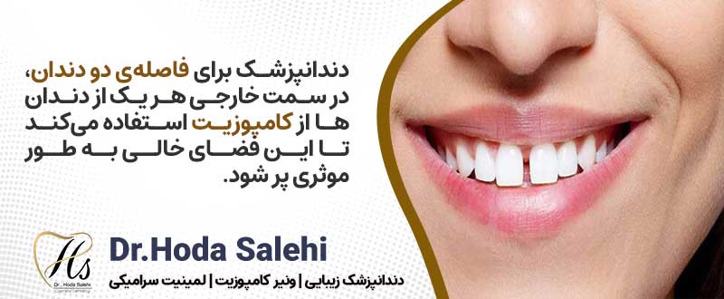 اصلاح طرح لبخند با کامپوزیت برای بستن فاصله بین دندان‌ها