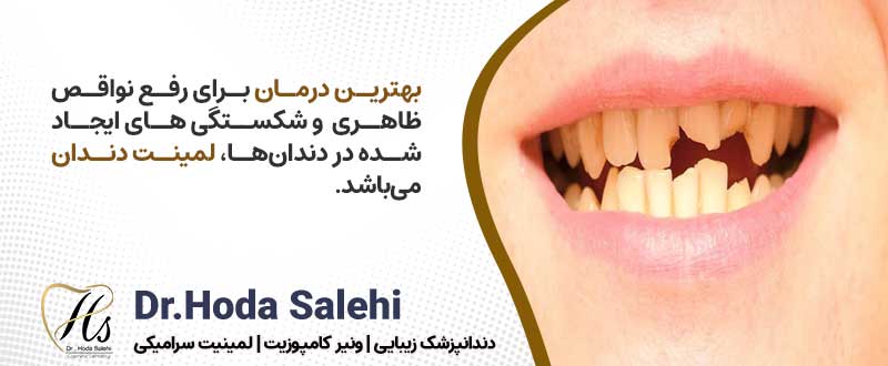 کسانی که دندان‌های شکسته و دارای لب پریدگی دارند گزینه مناسبی برای لمینت دندان می باشند
