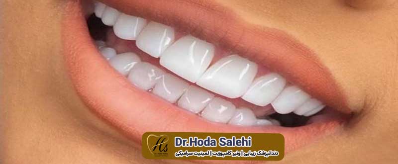 دکتر هدی صالحی|دندانپزشک زیبایی در اصفهان ارائه دهنده لمینت دندان خرگوشی