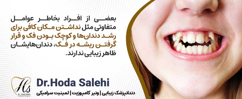 لمینت دندان برای کسانی که نیاز به تغییر فرم و سایز دندانهای خود دارند