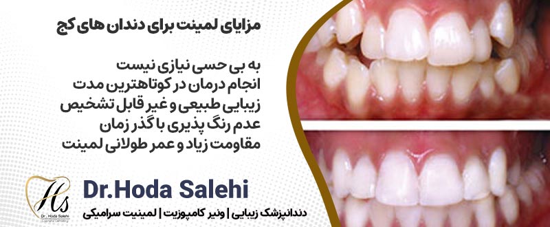 مزایای لمینت برای دندان های کج| دکتر هدی صالحی دندانپزشک زیبایی در اصفهان