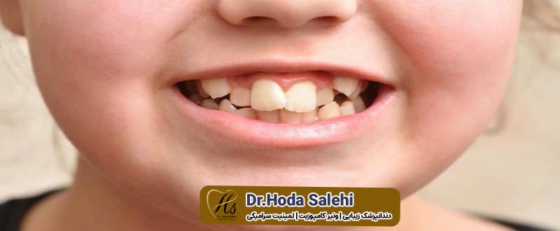 لمینت دندان کج|دکتر هدی صالحی دندانپزشک زیبایی در اصفهان