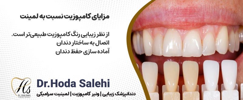 مزایای کامپوزیت دندان نسبت به لمینت دندان