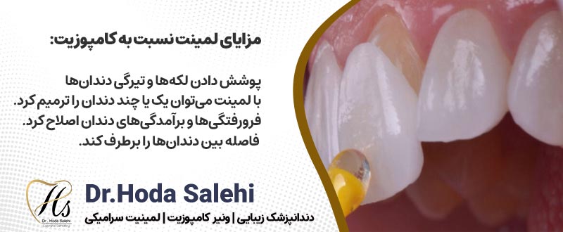 مزایای لمینت نسبت به کامپوزیت دکتر هدی صالحی دندانپزشک زیبایی در اصفهان