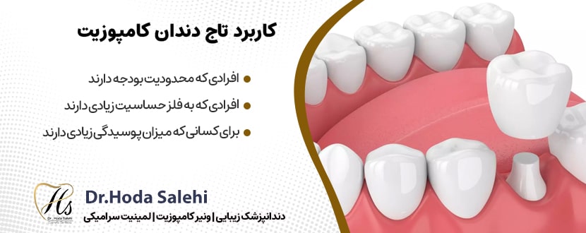 کاربردهای تاج دندان کامپوزیتی|دکتر هدی صالحی دندانپزشک زیبایی