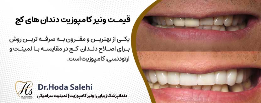 قیمت ونیر کامپوزیت برای دندان های کج در اصفهان