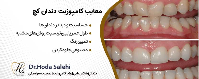 معایب کامپوزیت دندان کج