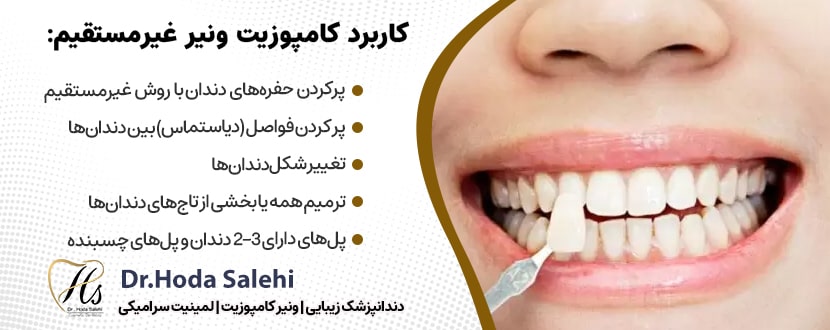 کامپوزیت ونیر غیر مستقیم یکی از انواع کامپوزیت دندان|دکتر هدی صالحی دندانپزشک زیبایی