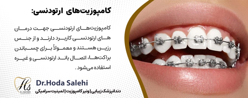 کامپوزیت ارتودنسی|دکتر هدی صالحی دندانپزشک زیبایی
