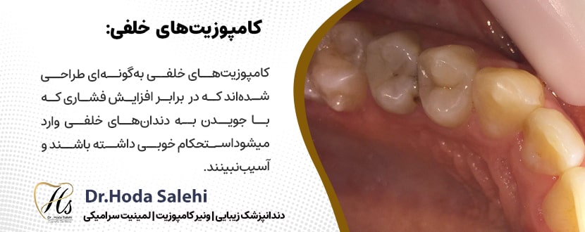 کامپوزیت خلفی یکی از انواع کامپوزیت دندان|دکتر هدی صالحی دندانپزشک زیبایی