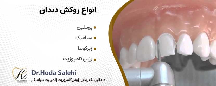 انواع روکش‌های دندانی|دکتر هدی صالحی دندانپزشک زیبایی