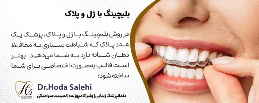 بلیچینگ با ژل و پلاک |دکتر هدی صالحی دندانپزشک زیبایی در اصفهان