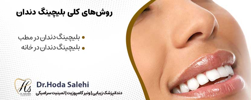  روش های کلی بلیچینگ دندان |دکتر هدی صالحی دندانپزشک زیبایی در اصفهان 