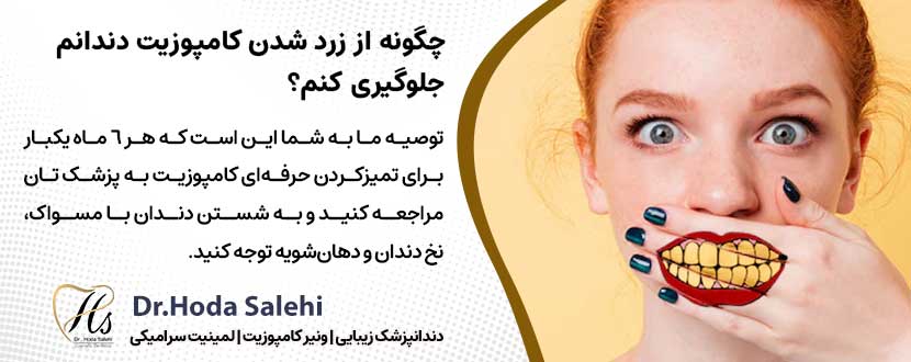 آیا کامپوزیت دندان نیاز به مراقبت ویژه‌ای دارد؟ |دکتر هدی صالحی دندانپزشک زیبایی در اصفهان
