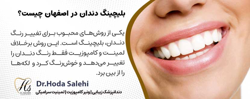 بلیچینگ چیست؟ |دکتر هدی صالحی دندانپزشک زیبایی در اصفهان