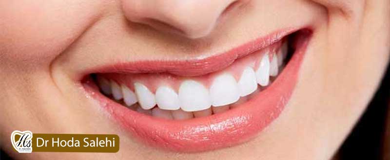 نکات طلایی مراقبت از کامپوزیت دندان |دکتر هدی صالحی دندانپزشک زیبایی در اصفهان