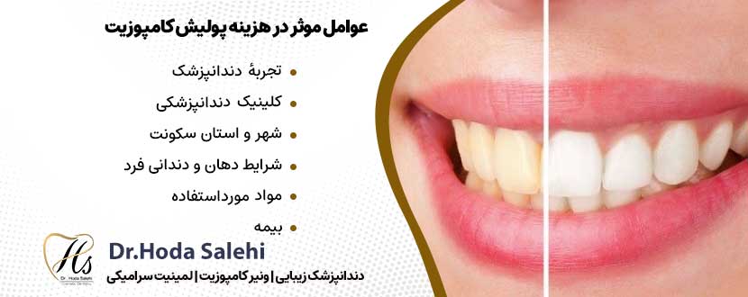هزینه پولیش دندان بعد از کامپوزیت |دکتر هدی صالحی دندانپزشک زیبایی در اصفهان