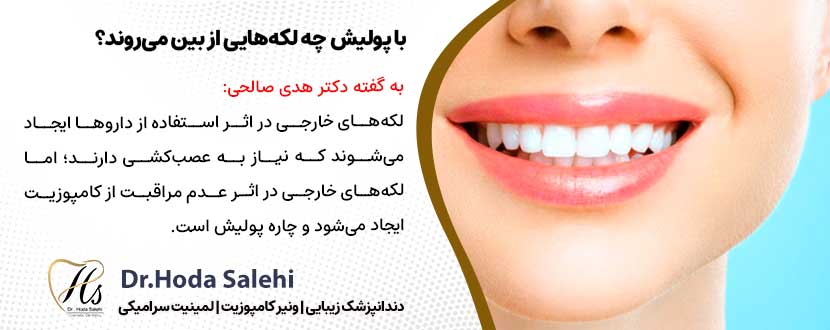 با استفاده از پولیش دندان بعد از کامپوزیت چه لکه‌هایی از بین می‌روند؟ |دکتر هدی صالحی دندانپزشک زیبایی در اصفهان