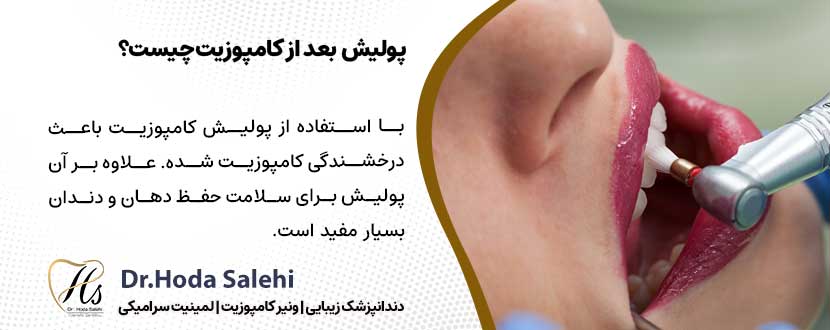 پولیش دندان بعد از کامپوزیت چیست؟ |دکتر هدی صالحی دندانپزشک زیبایی در اصفهان