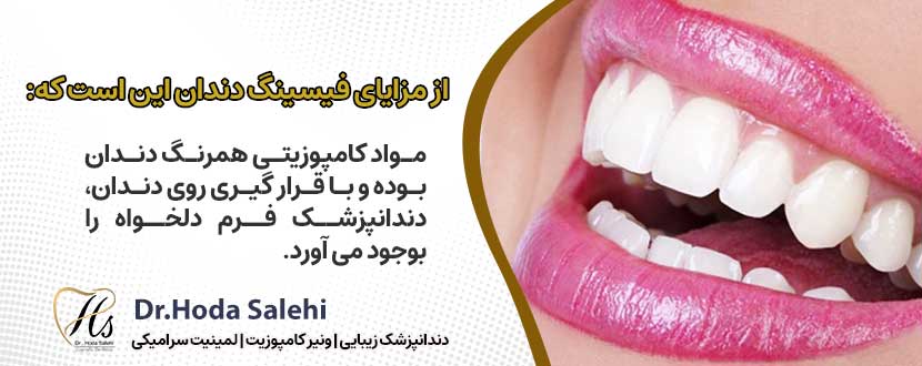 مزایای فیسینگ دندان