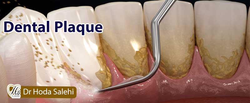 جرم گیری دندان مضر است یا مفید؟
