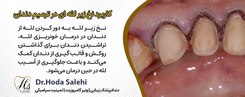 کاربرد نخ زیر لثه ای در ترمیم دندان