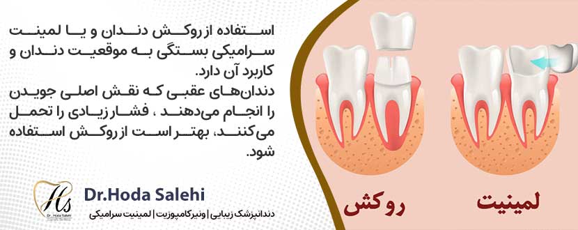 مناسب بودن روکش دندان برای دندان های عقبی به جای لیمنت دندان
