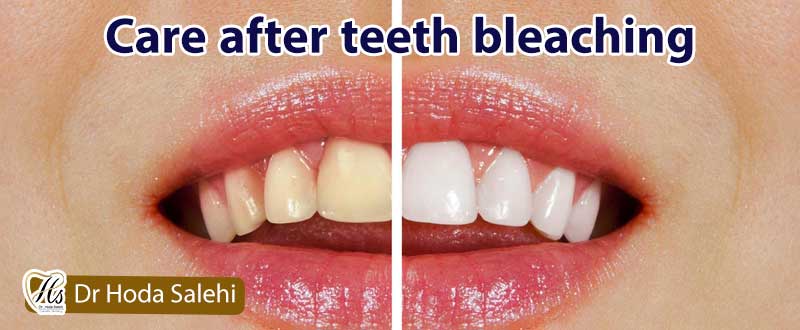 Care after teeth bleaching