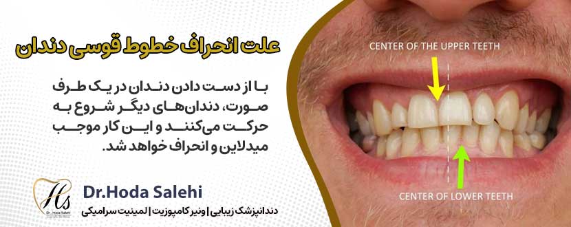 علت انحراف میدلاین یا خطوط قوسی دندان ها چیست؟