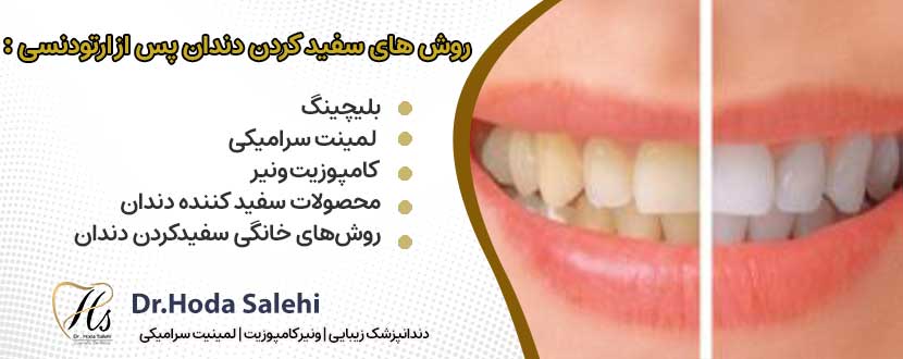 روش های سفید کردن دندان پس از ارتودنسی