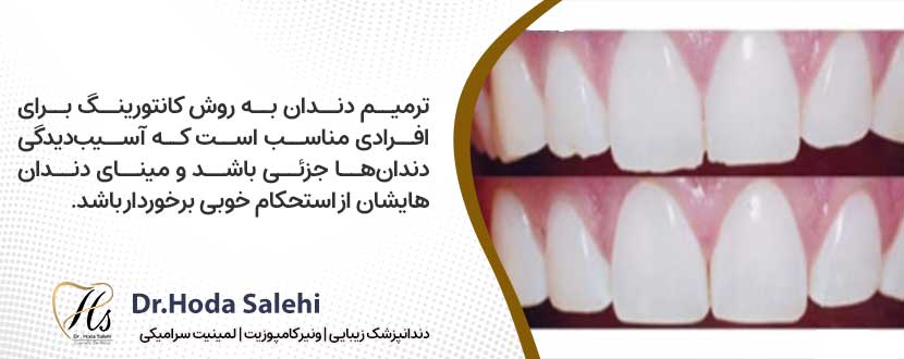 ویژگی دندان هایی که برای کانتورینگ مناسب هستند